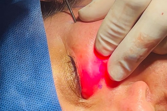 آیا اشعه لیزر اندولیفت خطرناک است؟