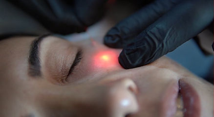 اندولیفت زیر چشم