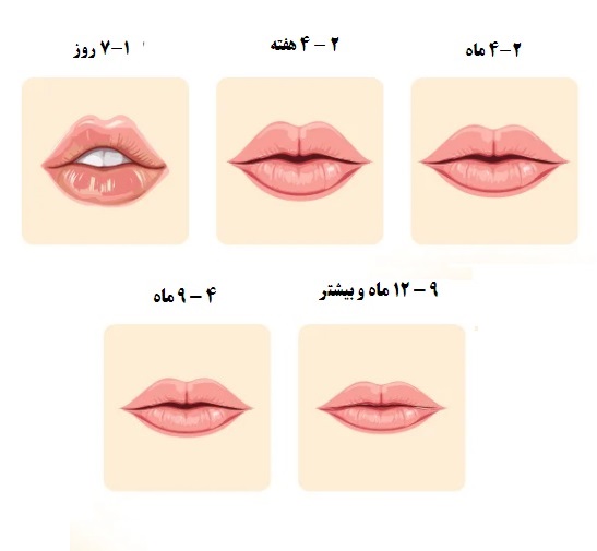 ماندگاری فیلرهای لب چقدر است؟