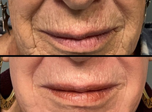 آشنایی با درمان لیزر اولترا کلییر( Ultraclear)