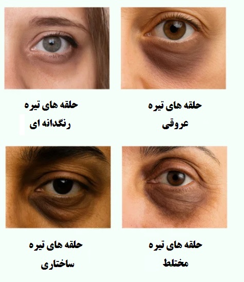 علل و درمان‌ انواع حلقه‌های تیره دور چشم