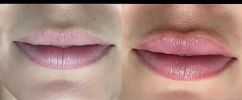 تزریق تنها نیم میلی لیتر فیلر لب